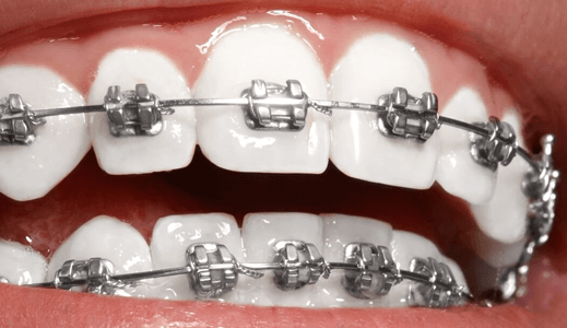 Исправление прикуса зубов при наличии коронок